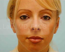 Otoplasty (Cosmetic Ear Reshaping)