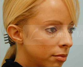Otoplasty (Cosmetic Ear Reshaping)
