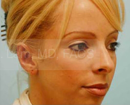 Otoplasty (Cosmetic Ear Reshaping)