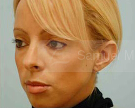 Otoplasty (Cosmetic Ear Reshaping)