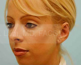 Otoplasty (Cosmetic Ear Reshaping)