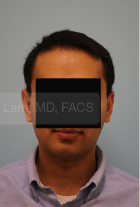 Otoplasty (Cosmetic Ear Reshaping)