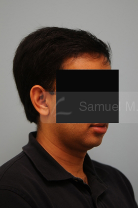 Otoplasty (Cosmetic Ear Reshaping)
