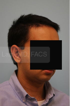 Otoplasty (Cosmetic Ear Reshaping)