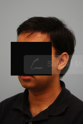 Otoplasty (Cosmetic Ear Reshaping)