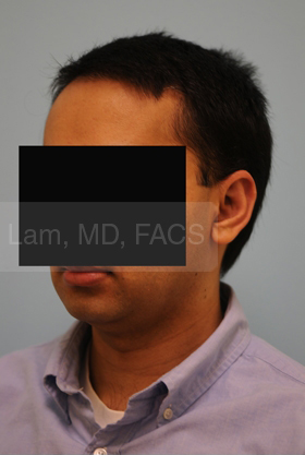 Otoplasty (Cosmetic Ear Reshaping)