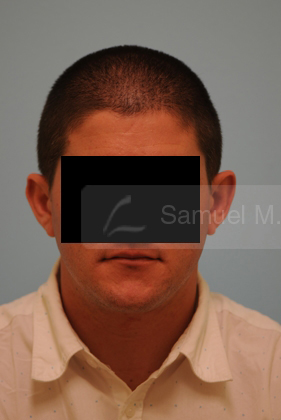 Otoplasty (Cosmetic Ear Reshaping)