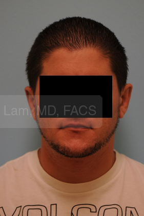 Otoplasty (Cosmetic Ear Reshaping)