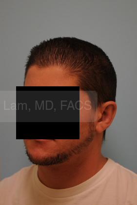 Otoplasty (Cosmetic Ear Reshaping)