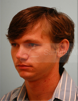 Otoplasty (Cosmetic Ear Reshaping)