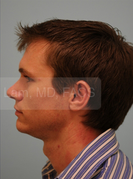 Otoplasty (Cosmetic Ear Reshaping)