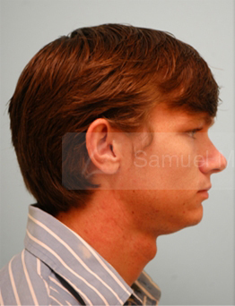 Otoplasty (Cosmetic Ear Reshaping)