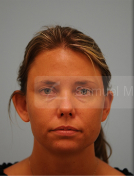 Otoplasty (Cosmetic Ear Reshaping)