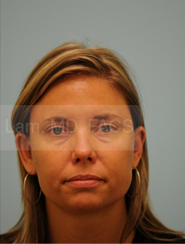 Otoplasty (Cosmetic Ear Reshaping)