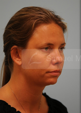Otoplasty (Cosmetic Ear Reshaping)
