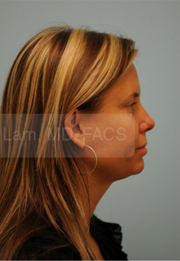 Otoplasty (Cosmetic Ear Reshaping)