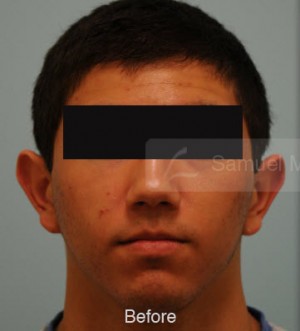 Otoplasty (Cosmetic Ear Reshaping)