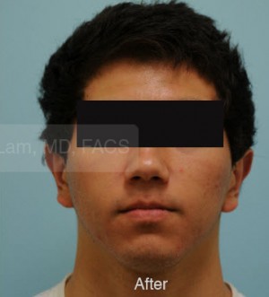 Otoplasty (Cosmetic Ear Reshaping)