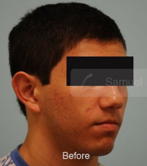Otoplasty (Cosmetic Ear Reshaping)