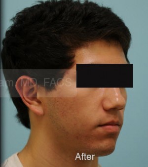 Otoplasty (Cosmetic Ear Reshaping)