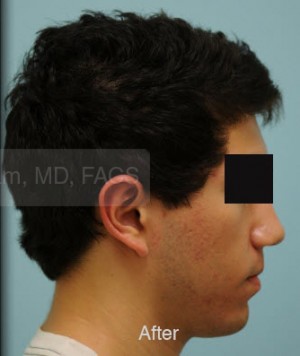 Otoplasty (Cosmetic Ear Reshaping)