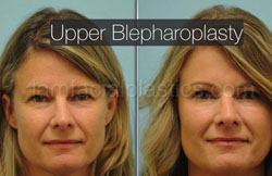 Upper Blepharoplasty Result Plano