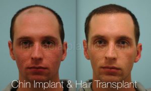 Chin Augmentation Result Dallas