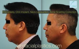 Chin Augmentation Result Dallas