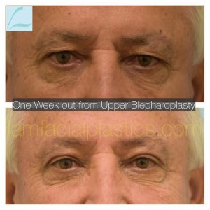 Upper Blepharoplasty Result Plano