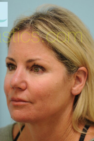 Primary Facial Fat Transfer