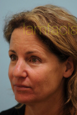 Primary Facial Fat Transfer