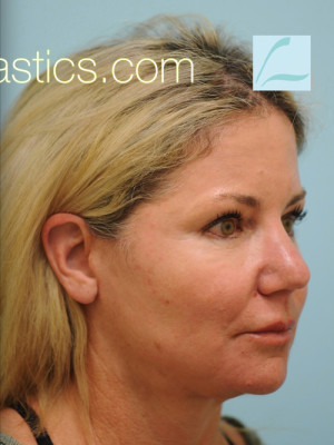 Primary Facial Fat Transfer