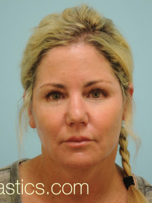 Primary Facial Fat Transfer