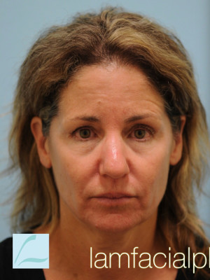 Primary Facial Fat Transfer