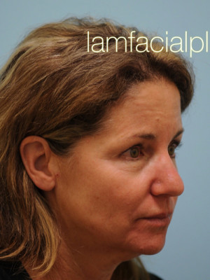 Primary Facial Fat Transfer
