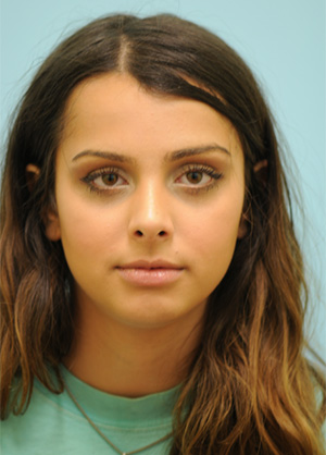 Rhinoplasty-Nose Job
