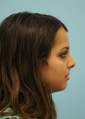 Rhinoplasty-Nose Job