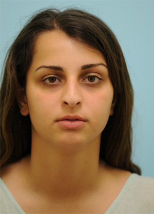 Rhinoplasty-Nose Job