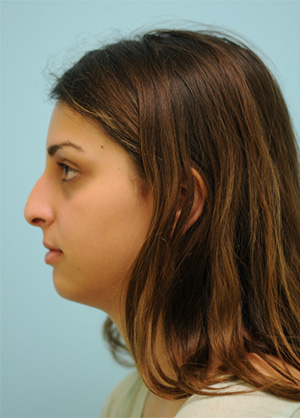 Rhinoplasty-Nose Job