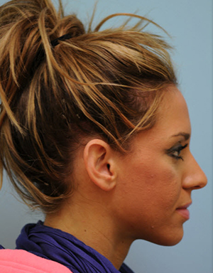 Otoplasty (Cosmetic Ear Reshaping)