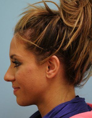 Otoplasty (Cosmetic Ear Reshaping)