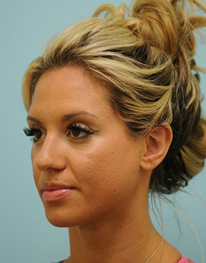 Otoplasty (Cosmetic Ear Reshaping)