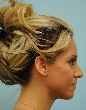 Otoplasty (Cosmetic Ear Reshaping)