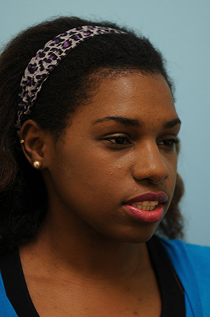 Rhinoplasty-Nose Job