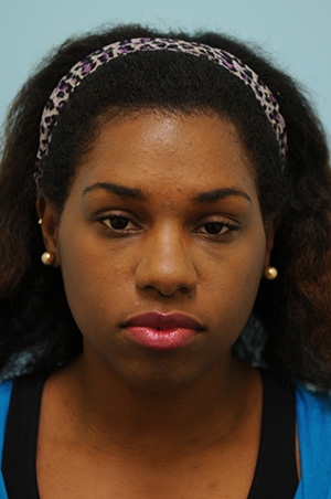 Rhinoplasty-Nose Job