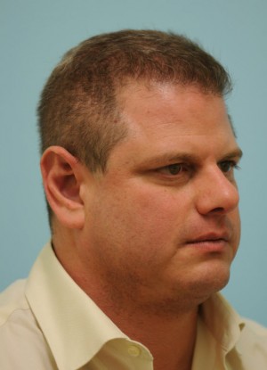 Chin Augmentation