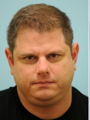 Chin Augmentation