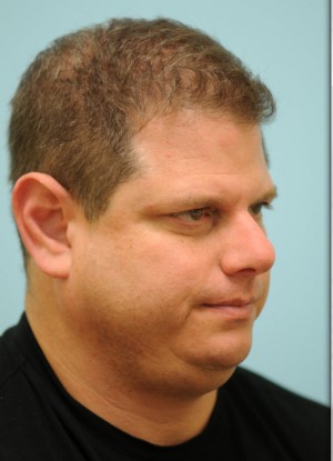 Chin Augmentation