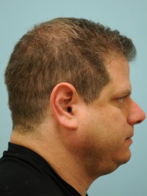 Chin Augmentation