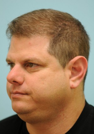 Chin Augmentation